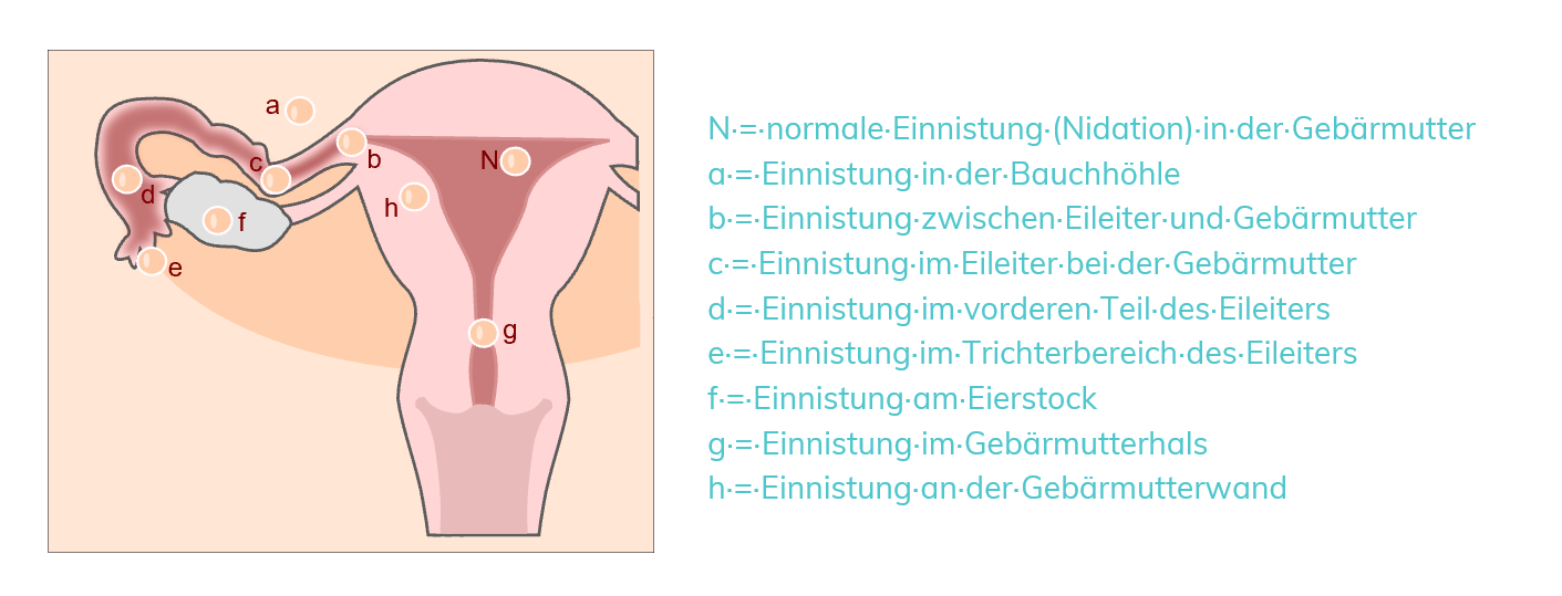 BABYOU • Ektope Schwangerschaft